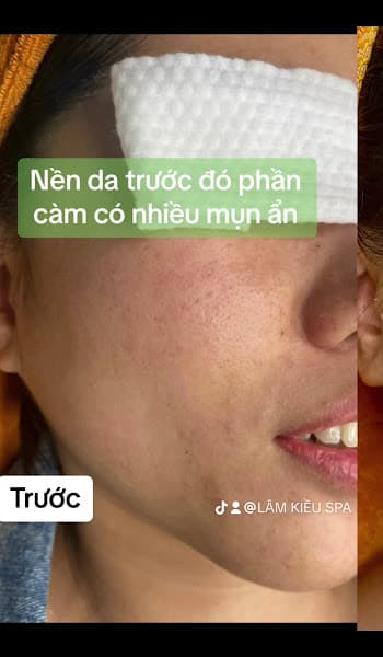 Hình ảnh Lâm Kiều Spa Tây Ninh chuyên Trị mụn - Trị nám - Trị sẹo - Xóa mụn thịt và Xoá xăm Tây Ninh - 5
