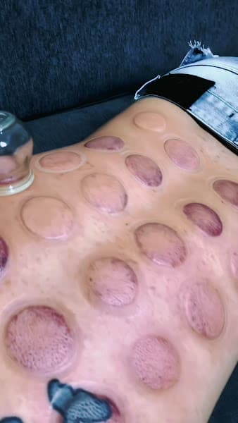 Hình ảnh MASSAGE -TRỊ LIỆU- NHẤN HUYỆT -GIÁC HƠI-Giá rẻ Tại nhà 마사지 받고 싶을 때 전화해 - 3