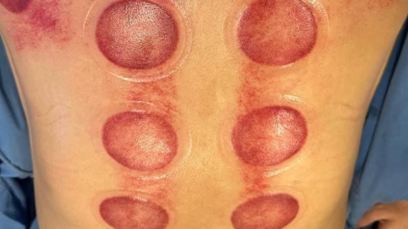 Ảnh bìa Massage Châm Cứu Bấm Huyệt Trị Liệu Hoa Đông y